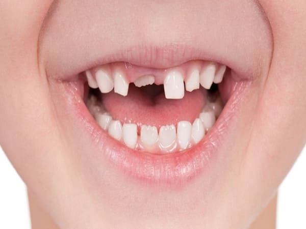 Bị gãy răng chọn số nào